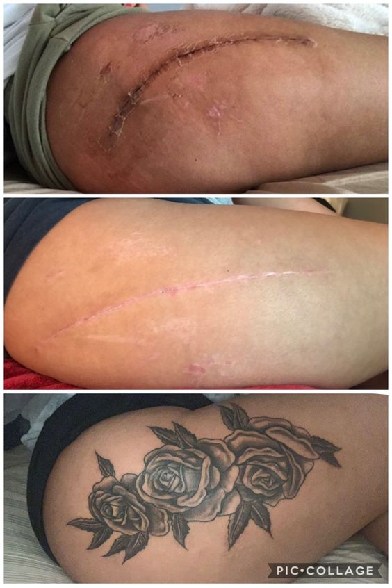 Hình xăm hoa hồng blackwork trên đùi che sẹo, phong cách chi tiết. Ảnh HD.