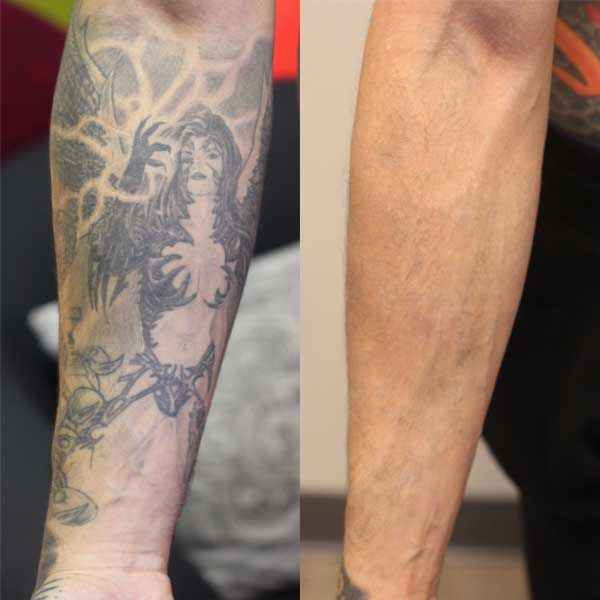 Hình xăm đen trắng trên cánh tay, phong cách blackwork chi tiết, ảnh HD, trước và sau khi xóa.
